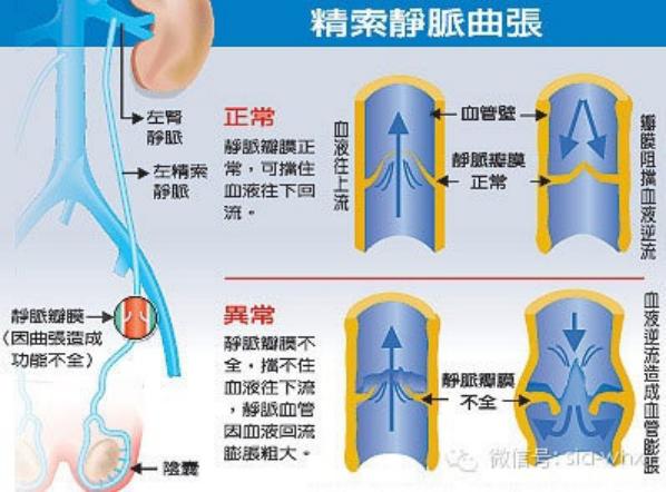 關(guān)于2021年征兵精索靜脈曲張標(biāo)準(zhǔn)的探討，2021年征兵精索靜脈曲張標(biāo)準(zhǔn)深度解析