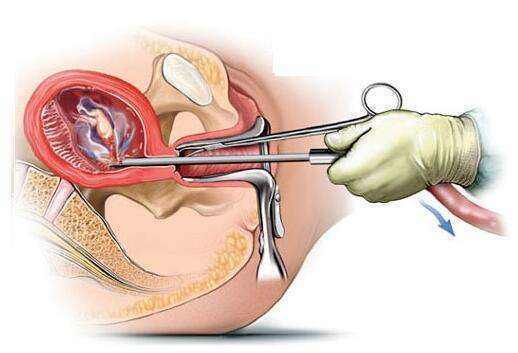 無痛人流術(shù)后醒來的疼痛感受解析，無痛人流術(shù)后醒來的疼痛感受解析及應(yīng)對(duì)建議