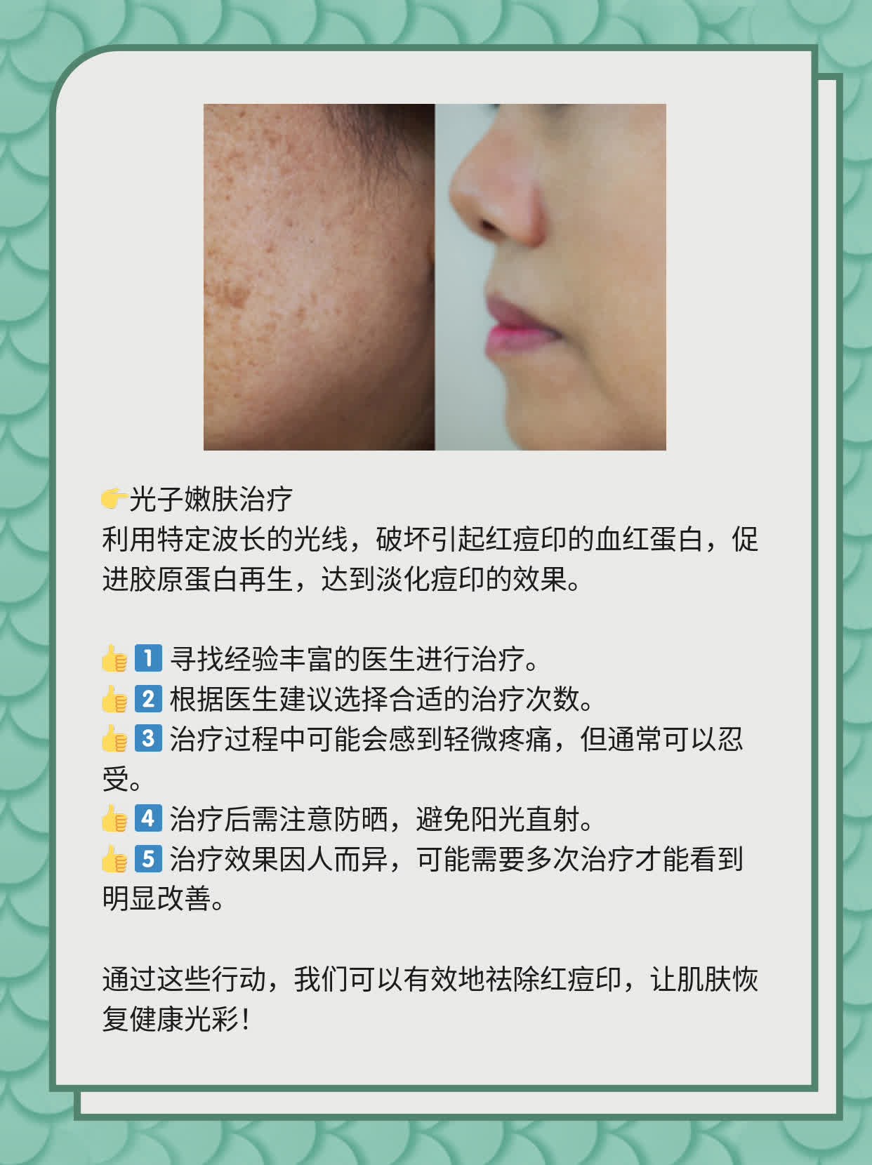 如何有效去除紅痘印，一站式解決方案，一站式解決紅痘印問題，有效去除方法大全