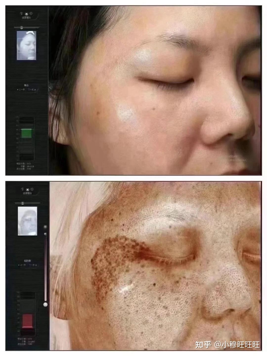 激光祛斑，選擇醫(yī)院還是美容院？全面解讀助您做出明智決策，激光祛斑，如何選擇醫(yī)院與美容院？全面解讀為您指明決策方向