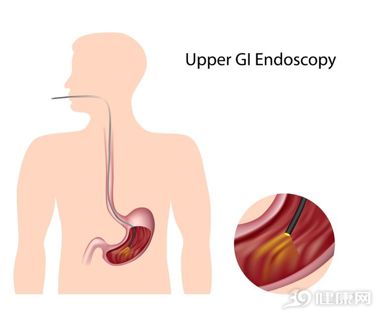 做胃鏡難受嗎？全面解析胃鏡檢查的體驗(yàn)與注意事項(xiàng)，胃鏡檢查全面解析，體驗(yàn)、難受程度及注意事項(xiàng)探討