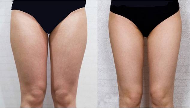 抽脂減肥反彈現(xiàn)象，原因與應(yīng)對(duì)策略，抽脂減肥反彈原因及應(yīng)對(duì)策略解析