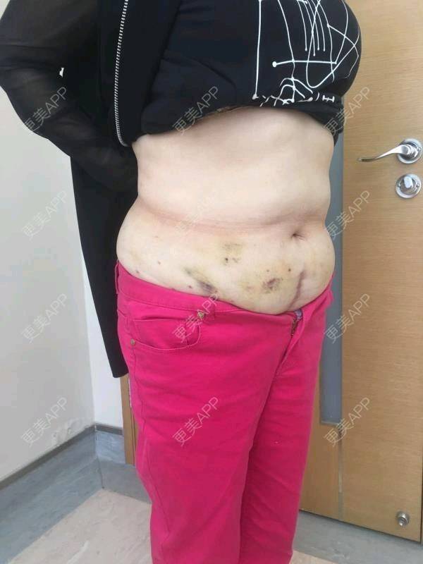 腰腹吸脂后1到7天恢復(fù)過程圖片展示，腰腹吸脂術(shù)后恢復(fù)過程圖片展示（1-7天）