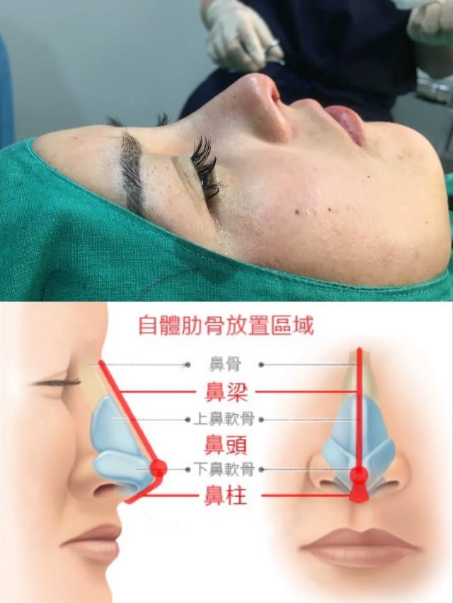 鼻綜合整形項目詳解，包括哪些項目？，鼻綜合整形項目詳解，涵蓋內(nèi)容與整形項目概覽