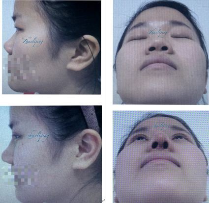 鼻頭縮小整形價(jià)格詳解，因素、費(fèi)用及注意事項(xiàng)，鼻頭縮小整形價(jià)格解析，費(fèi)用、因素與注意事項(xiàng)全指南