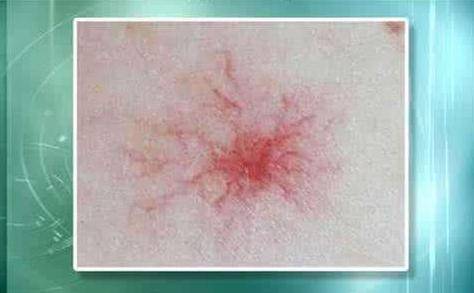 肝癌身上出現(xiàn)紅點圖片，癥狀解析與關(guān)注，肝癌身上紅點解析，癥狀、圖片及關(guān)注重點