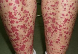 皮膚上有小紅點像血點，原因、診斷與處理方法，皮膚小紅點解析，成因、診斷及應對方法