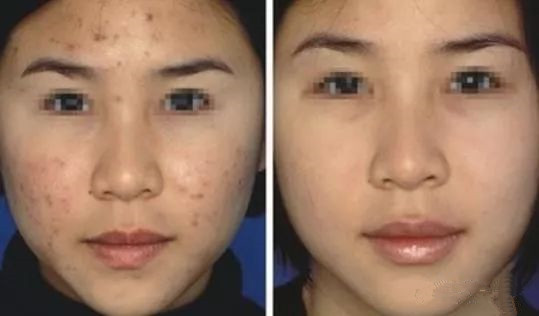 去痘痘的最快方法，針對青少年肌膚的有效解決方案（適合18歲以下人群），針對青少年肌膚的快速祛痘方法，適合18歲以下人群的有效解決方案