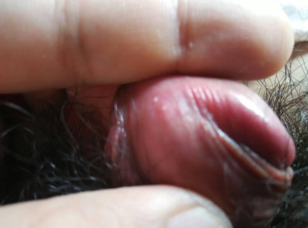 醋酸白疣體變白對照圖片，深入了解與識別，醋酸白疣體變白詳解，識別與對照圖片指南