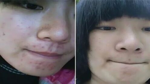 快速消除痘印的有效方法與建議，快速消除痘印的有效方法與建議，實(shí)用建議助你恢復(fù)無(wú)瑕肌膚