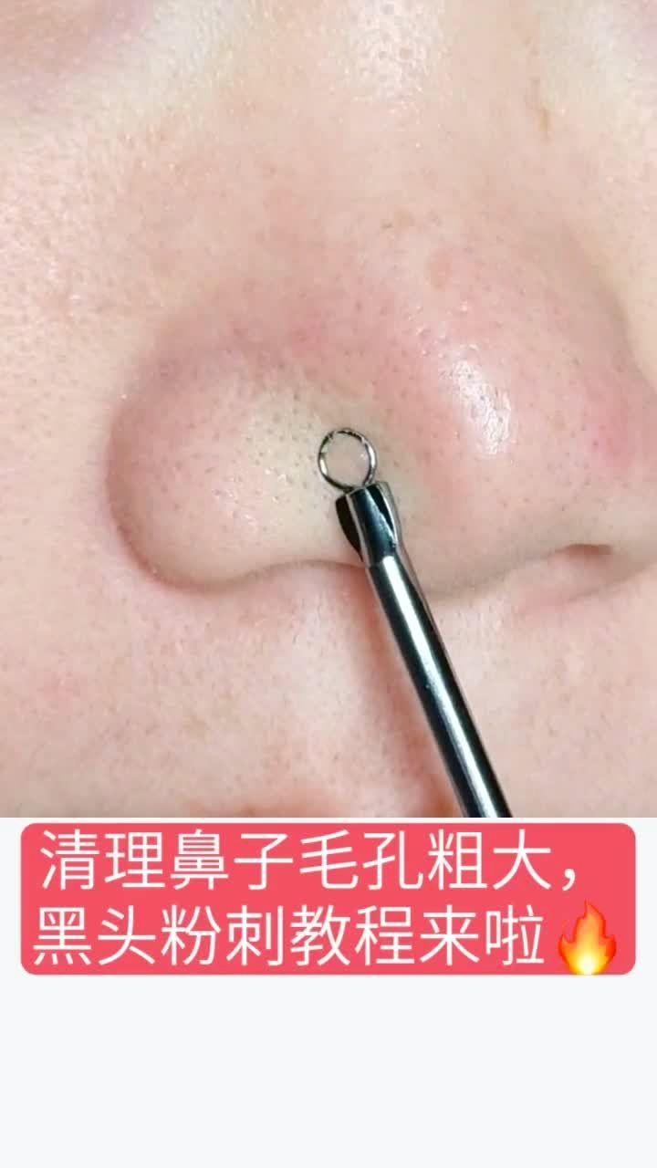 去黑頭小妙招，輕松告別黑頭煩惱，告別黑頭煩惱！實用去黑頭小妙招分享